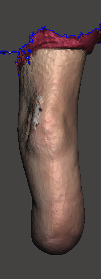 ResidualLimb